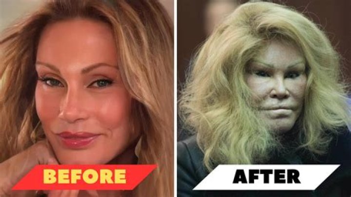 Ana Jalandoni Before and After Surgery Pictures, Actress Sustained Injuries After Kit Thompson Abuse